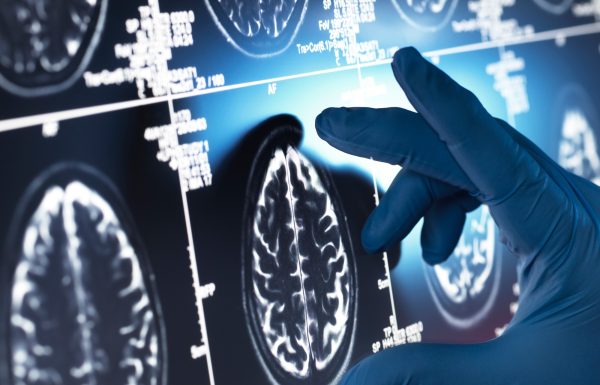 Neurology Research, Doctor examining a human brain scan on screen